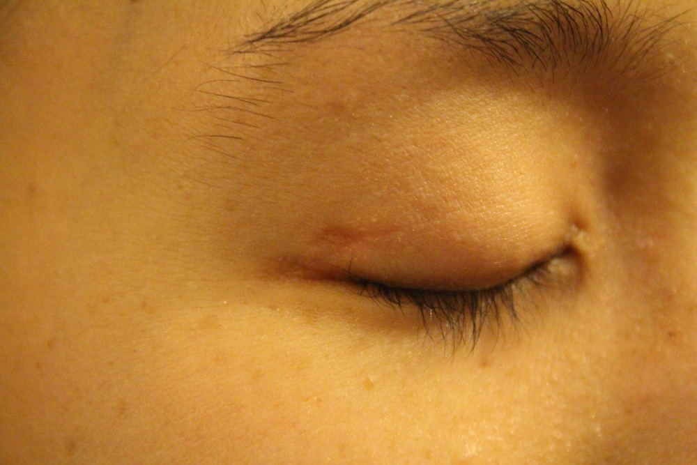 Closed eyelid with small scar